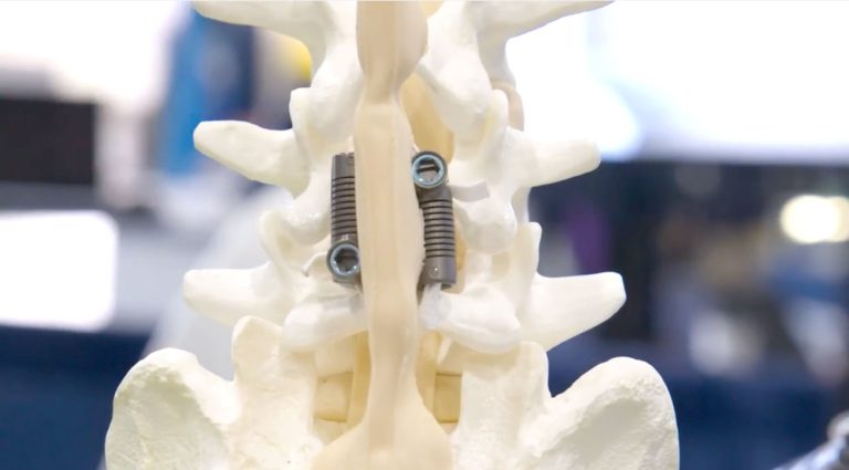 LimiFlex Dynamic Sagittal Tether